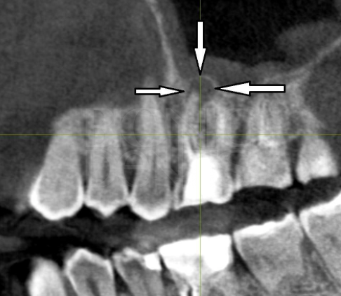 Гранулема зуба на снимке