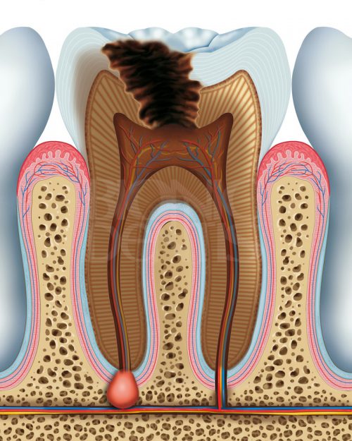 Лечение пульпита в стоматологии "Бионик Дентис"