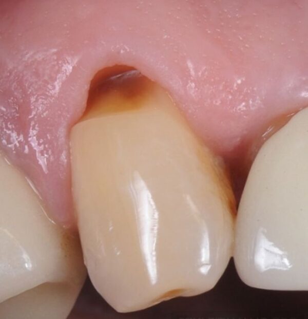 пришеечный кариес зуба