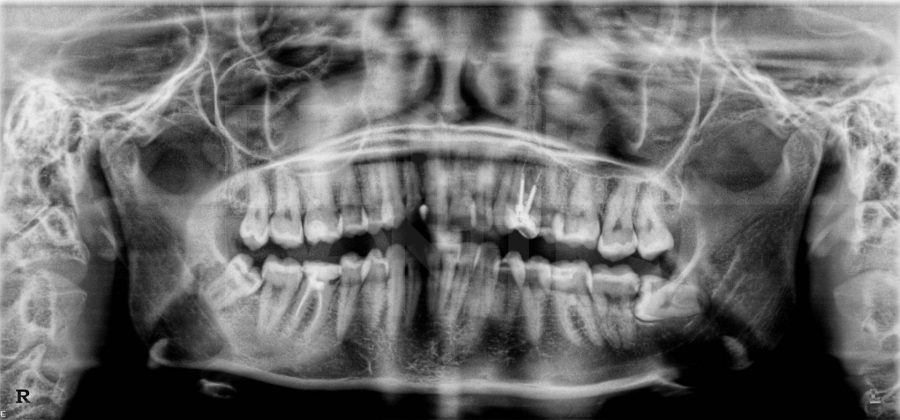 Удаление 8 зуба отзывы