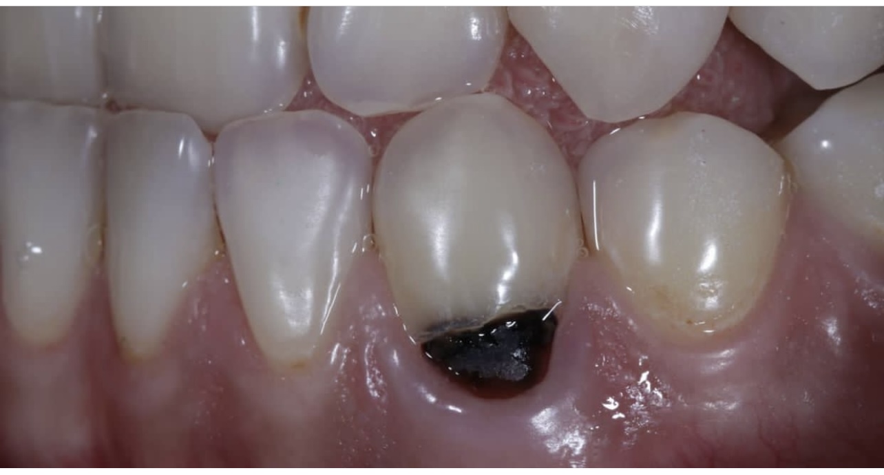 пришеечный кариес зуба