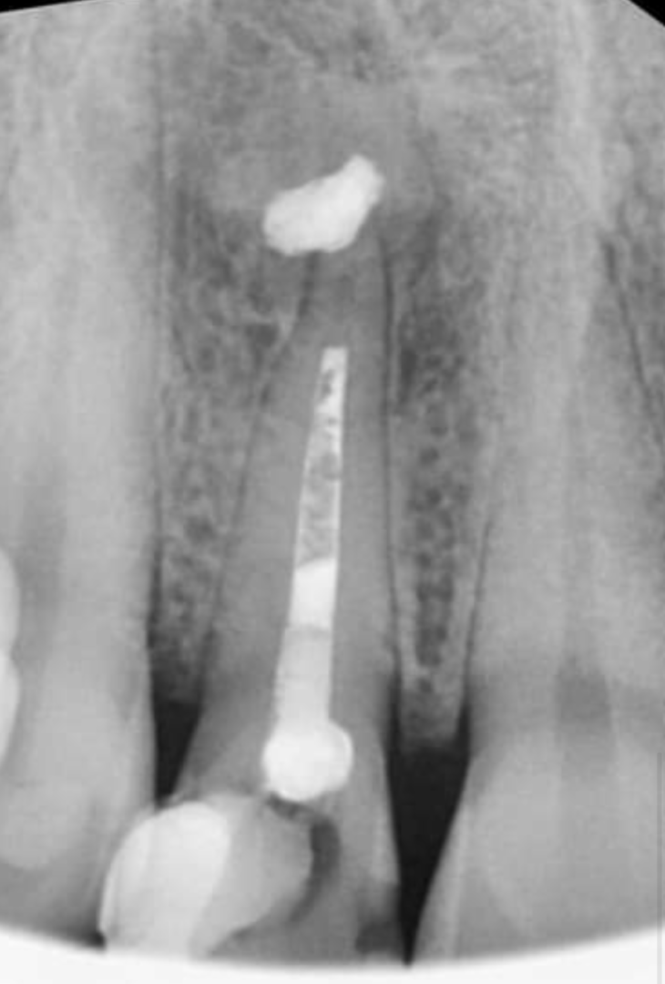 воспаление зуба