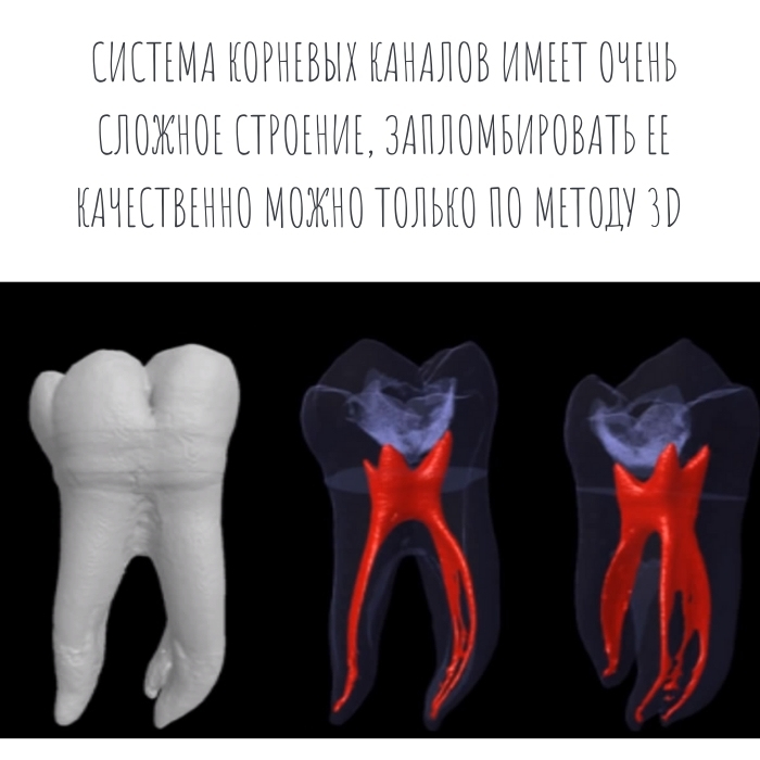 перфорация зуба