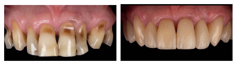 клиновидный дефект зуба