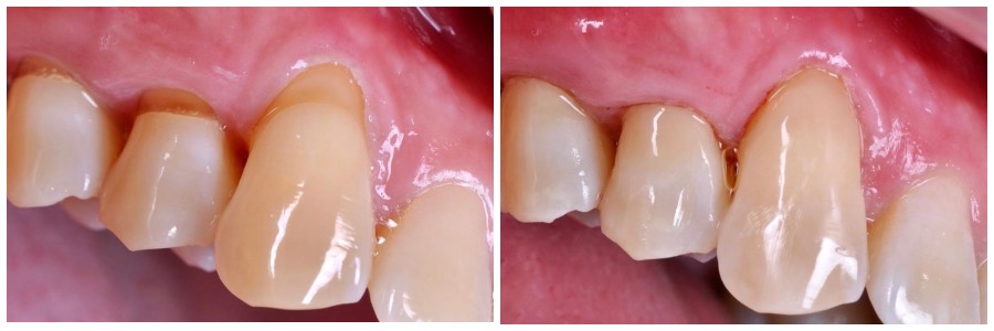 клиновидный дефект зуба