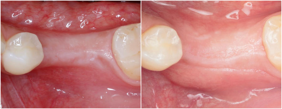 костная пластика в стоматологии