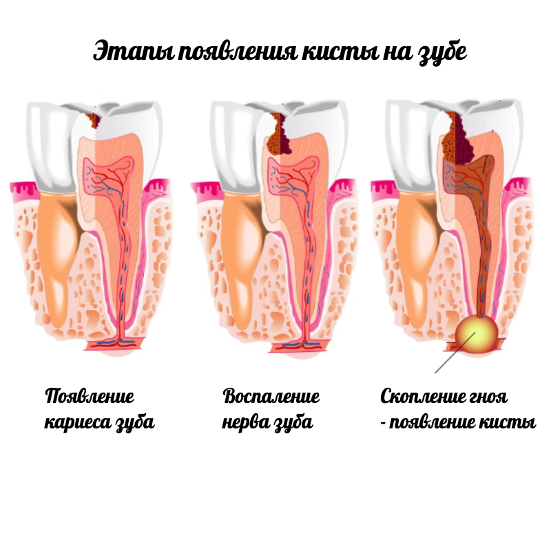 причины кисты зуба