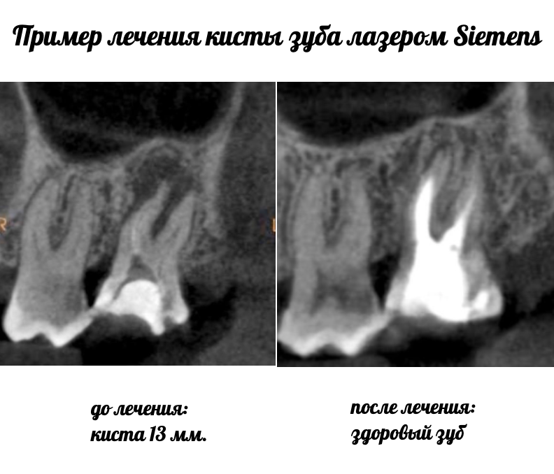 удаление кисты зуба без удаления зуба