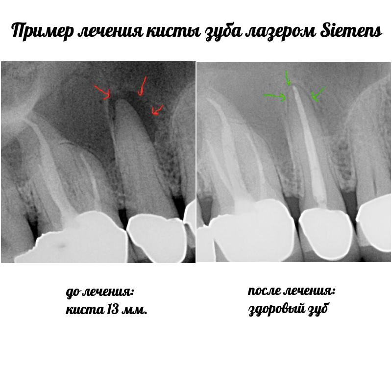 лечение кисты зуба без удаления