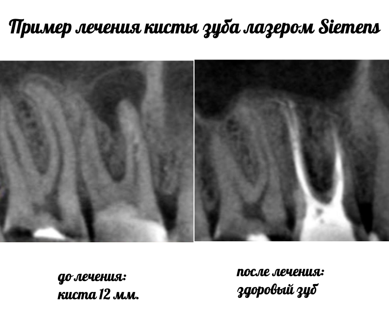 лечение кисты зуба без удаление зуба