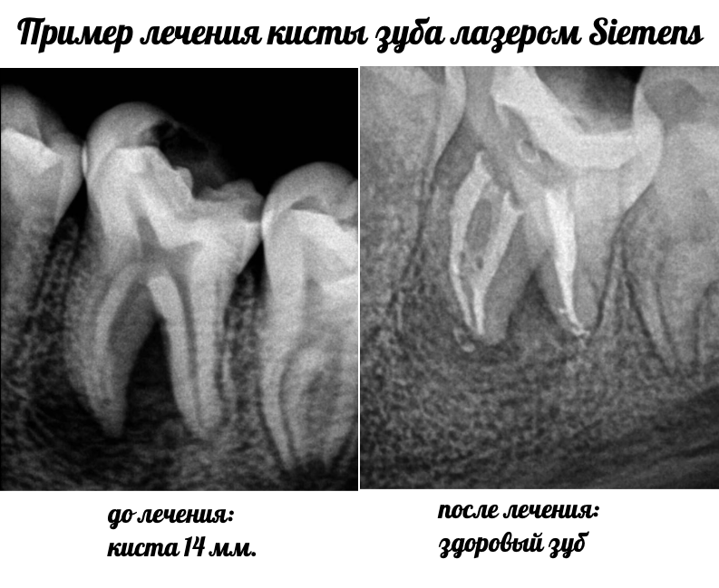 лечение кисты зуба