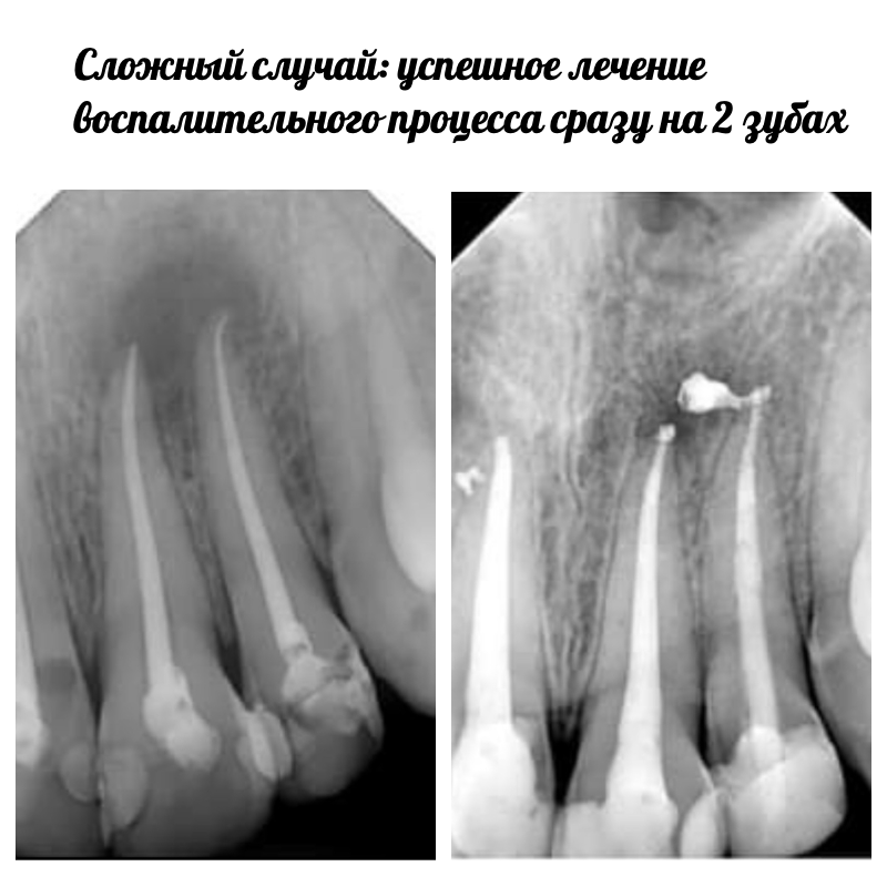 гранулемы зуба