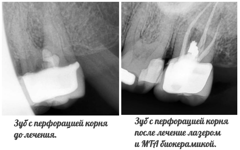 перфорация зуба