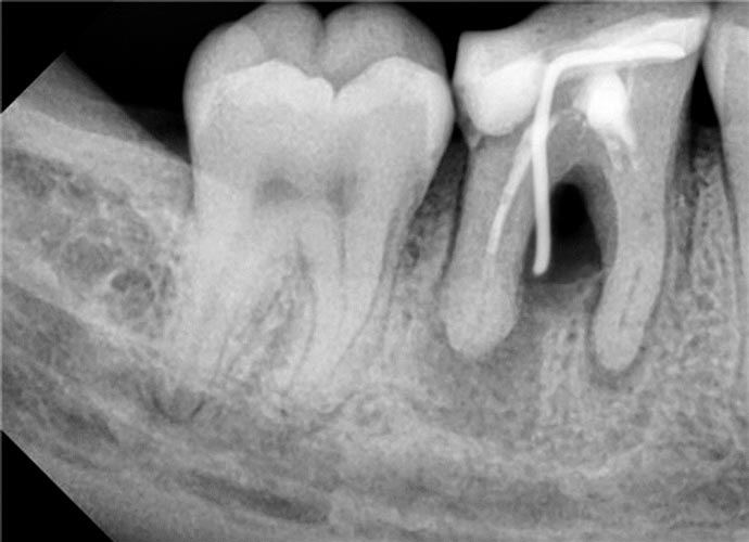 перфорация корня зуба
